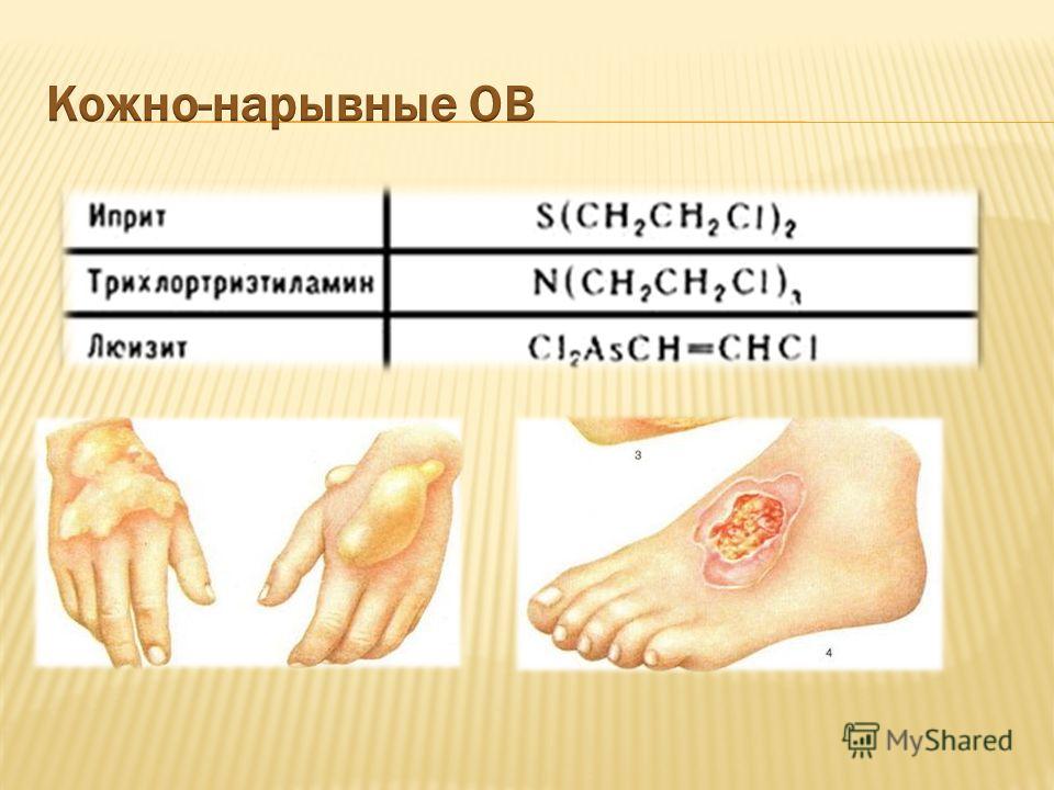 Иприт какой запах. Сравнительная характеристика поражения кожи ипритом и люизитом. Диагностика кожного поражения ипритом.