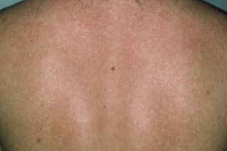 A spotty rash on the back of someone with dark skin