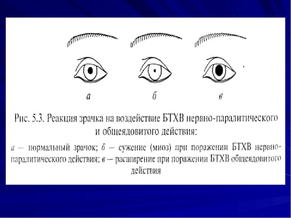 Реакция зрачка на свет. БТХВ нервно-паралитического действия. Признаки поражения человека БТХВ нервно паралитического действия. Реакция зрачка на гипоксию.